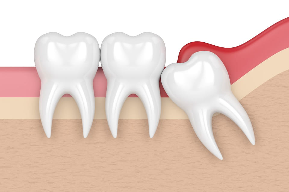 Everything You Need to Know About Wisdom Teeth 1 wisdom teeth