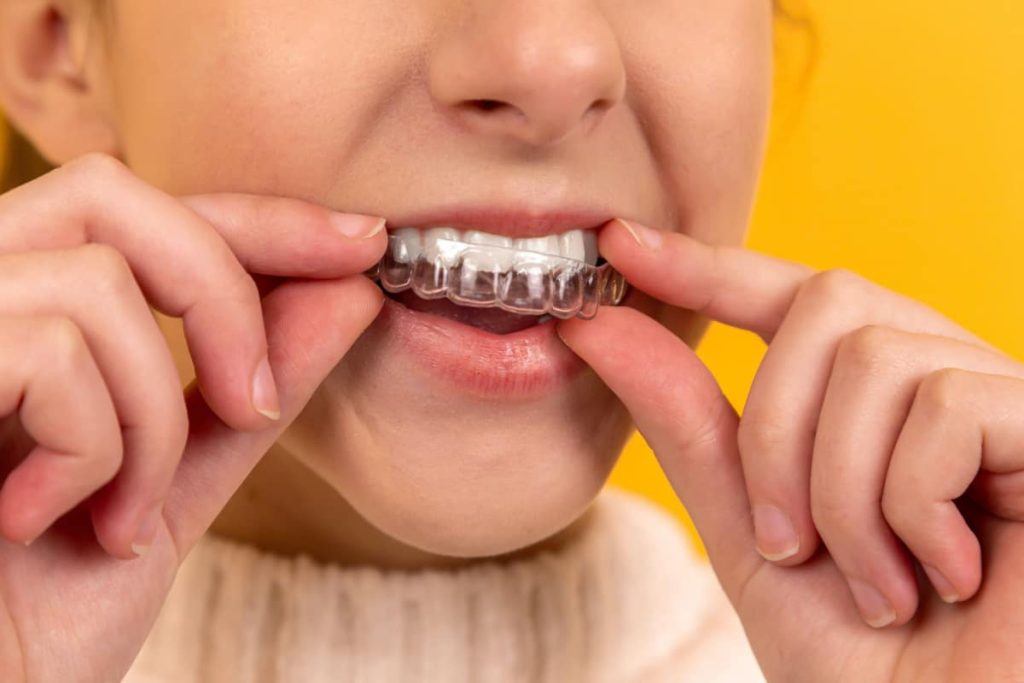 5 Benefits of Invisible Braces 1 Invisible Braces