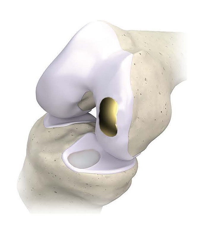 Overture Orthopaedics Announces Full Commercial Launch of the OvertureTi Knee Resurfacing System® to Treat Early Osteoarthritis and Cartilage Defects 7 Overture Orthopaedics OvertureTi Knee Resurfacing System