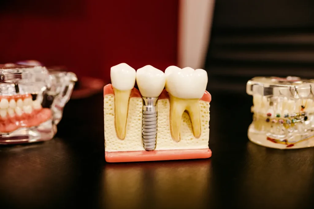 Rediscovering the Power of a Complete Smile: The Real Benefits of Dental Implants