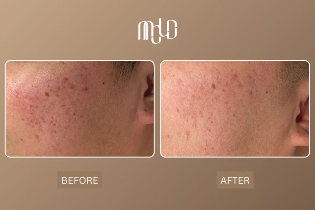 Over 100 Clients Successfully Treated for Acne Scars at Mold Manila Through Science-Led, Personalized Care